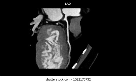 Left Anterior Descending (LAD, Interventricular) Artery Branches Curve With Computed Tomography Angiography, CTA Coronary Angiogram