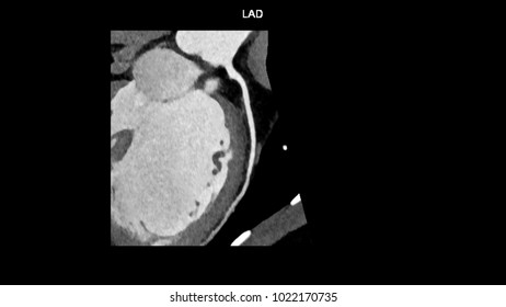 Left Anterior Descending (LAD, Interventricular) Artery Branches Curve With Computed Tomography Angiography, CTA Coronary Angiogram