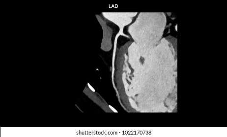 Left Anterior Descending (LAD, Interventricular) Artery Branches Curve With Computed Tomography Angiography, CTA Coronary Angiogram