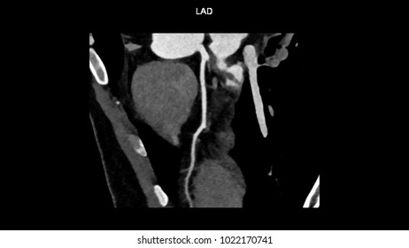 Left Anterior Descending (LAD, Interventricular) Artery Branches Curve With Computed Tomography Angiography, CTA Coronary Angiogram