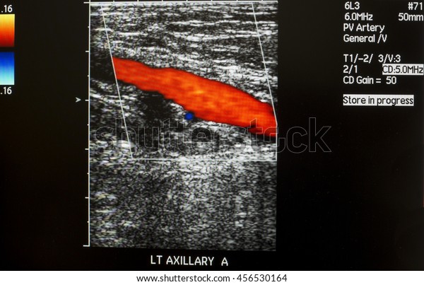 Left Axillary Artery Doppler Ultrasound Stock Photo Edit Now 456530164