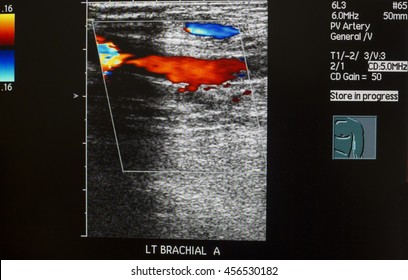 Left Brachial Artery Doppler Ultrasound