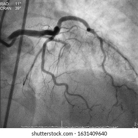 The left coronary artery angiogram (CAG) was performed chronic total occlusion (CTO) left anterior descending artery (LAD)