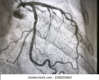 Left Coronary Artery Angiogram During Cardiac Catheterization.