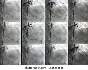 Left Coronary Artery Angiogram During Percutaneous Coronary Intervention (PCI).