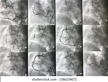 Left Coronary Artery Angiogram During Percutaneous Coronary Intervention (PCI).