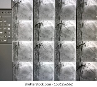 Left Coronary Artery Angiogram During Percutaneous Coronary Intervention (PCI).