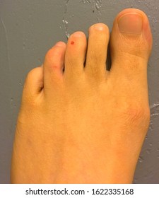 Left Foot Bleeding Due To Stubbed Toe