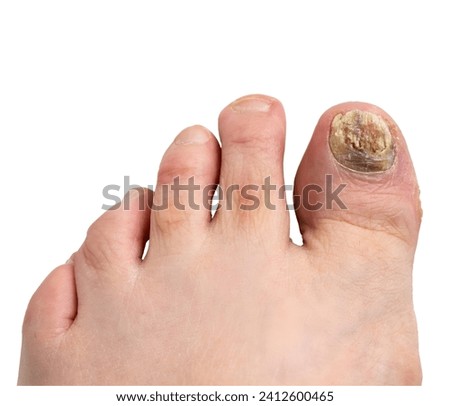 Left foot with nail fungus thickened, discolored and ragged in the big toe and the second toe. Long nails and toe hair in white background. Macrophotograph with bright twin macro flash lights.