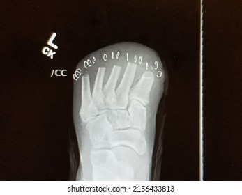 10 Transmetatarsal Images, Stock Photos & Vectors | Shutterstock