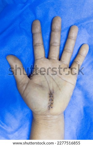 The left hand of female after open carpal tunnel release surgery on blue surgical drape with surgical incision.The stitches remained in palm after surgery that prepare for removal.Median nerve injury.