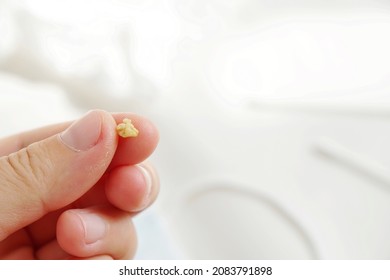 Left Hand Holding Tonsils Stone Tonsillolith Stock Photo 2083791898 ...