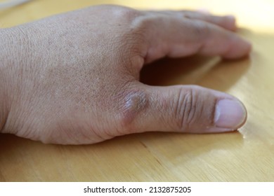 Left Hand Wound Thumb Area Caused Stock Photo 2132875205 | Shutterstock