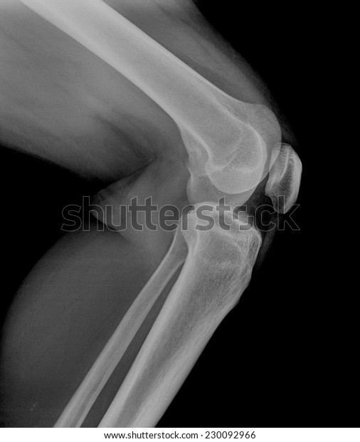 Left Knee Joint Xray Photos Lateral Stock Photo 230092966 | Shutterstock