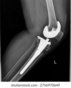 Left Knee Total Knee Replacement Lateral View X Ray Showing Prosthetic Implant
