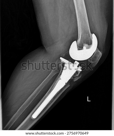 Left Knee Total Knee Replacement Lateral View X Ray Showing Prosthetic Implant