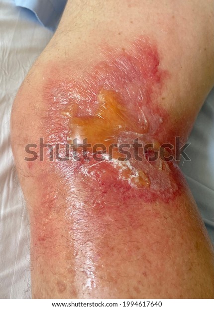 The left leg in a man who has severe skin and soft\
tissue infection. 