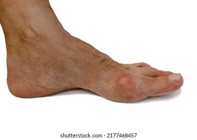 Left Leg With Painful Swollen Inflammation Of Gout,initial Stage