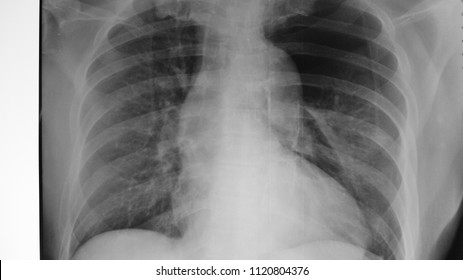 Left Lung Pneumothorax On Chest Xray Stock Photo (edit Now) 1120804376