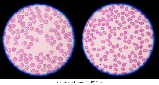 Left Red Blood Cels Target Cells Morphology,right Ovalocytes Rbc Morphology.