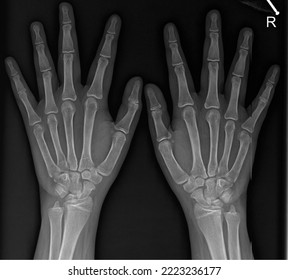 Left and Right Hand Posteroanterior Radiograph  - Shutterstock ID 2223236177