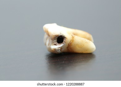 Left Rotten Cavity Molar Stock Photo 1220288887 | Shutterstock