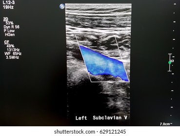 Left Subclavian Vein