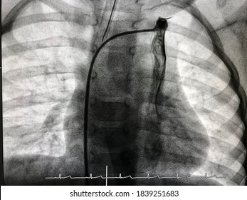 Left Superior Vena Cava (SVC) angiogram in patient with congenital heart disease.