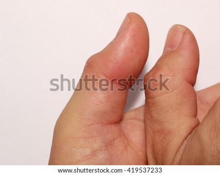 left thumb pain Left thumb pain
