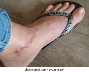 Leg of caucasian woman in flip flops who suffers from broken ankle. Scar on left foot after surgery. Overhead view.