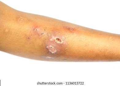 Scabies Images, Stock Photos & Vectors | Shutterstock