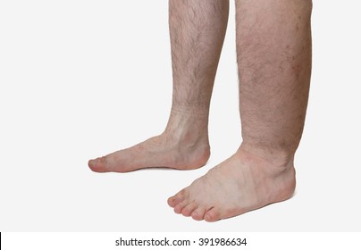 Leg Of Diseased Patient Who Suffers From Edema.