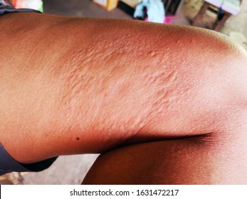 Leg Of Female With Redness On The Skin, Suffering From Food Allergies, Female's Leg Covered By Eczema. Body Acne Man Scratching Itchy Pimples On Back Leg Thigh -skin Allergy To Poison Ivy.