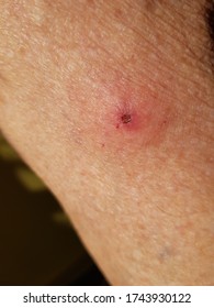 Leg Inflamed After Tick Bite. Hanover, Germany