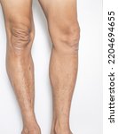Leg and knee joints of the elderly with muscle and bone degeneration lesion, dermatitis, dark spots of the skin on the legs on a white backdrop	
