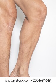 Leg And Knee Joints Of The Elderly With Muscle And Bone Degeneration Lesion, Dermatitis, Dark Spots Of The Skin On The Legs On A White Backdrop	