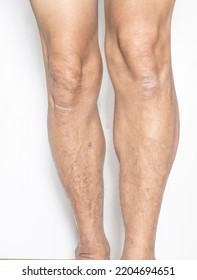 Leg And Knee Joints Of The Elderly With Muscle And Bone Degeneration Lesion, Dermatitis, Dark Spots Of The Skin On The Legs On A White Backdrop	