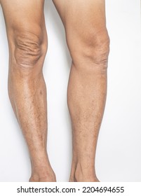 Leg And Knee Joints Of The Elderly With Muscle And Bone Degeneration Lesion, Dermatitis, Dark Spots Of The Skin On The Legs On A White Backdrop	