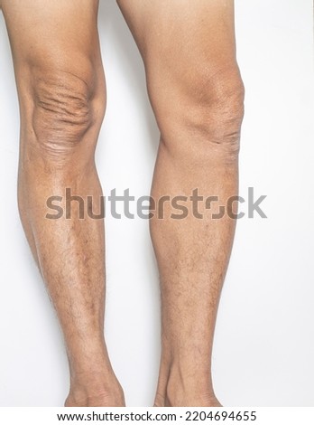 Leg and knee joints of the elderly with muscle and bone degeneration lesion, dermatitis, dark spots of the skin on the legs on a white backdrop	