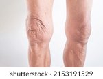 Leg and knee of an old man with synovial problems on a white background	
