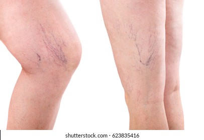 Leg. Legs With Varicose Spider Veins 