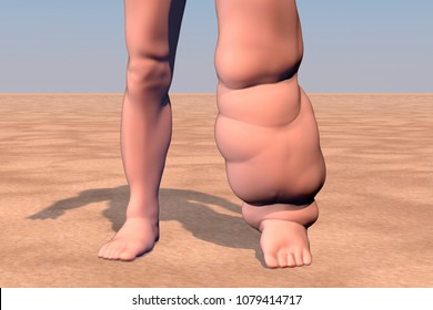 Leg of a person with elephantiasis, or lymphatic filariasis, 3D illustration. A disease caused by nematode worms Wuchereria bancrofti and other, transmitted by mosquito bite