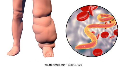 Leg of a person with elephantiasis, or lymphatic filariasis and close-up view of microfilariae in blood, 3D illustration. A disease caused by worms Wuchereria bancrofti, transmitted by mosquito bite