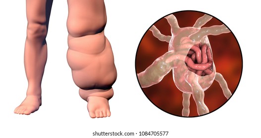 Leg of a person with elephantiasis, or lymphatic filariasis and close-up view of filariae worms blocking lymph node, 3D illustration