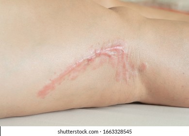 Leg Scars, Surgical Wounds, Internal Bone Repair Pain And Inflammation Of Muscles And Red Skin