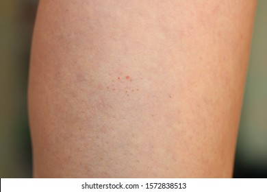 Leg Showing Capillaritis Due To Leaking Capillary Blood Vessels Also Known As Schamberg Disease. Rust-colored Spots