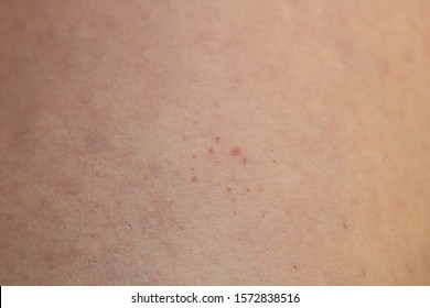 Leg Showing Capillaritis Due To Leaking Capillary Blood Vessels Also Known As Schamberg Disease. Rust-colored Spots