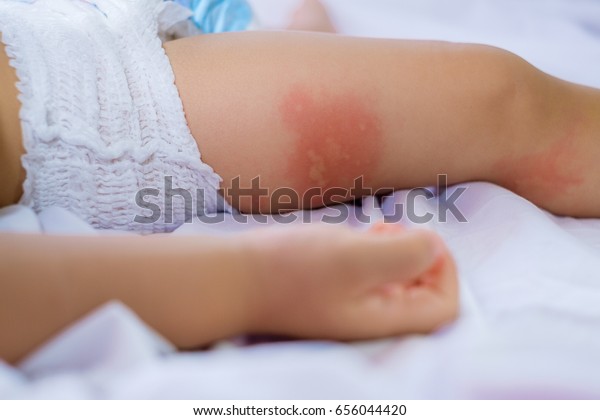 皮膚に赤みを帯びた睡眠中の小さな子どもの脚 食物アレルギーに苦しむこと 赤ん坊の脚は湿疹で覆われている 赤ちゃんアレルギー皮膚炎食品 原因不明の皮膚炎症状の発疹 の写真素材 今すぐ編集