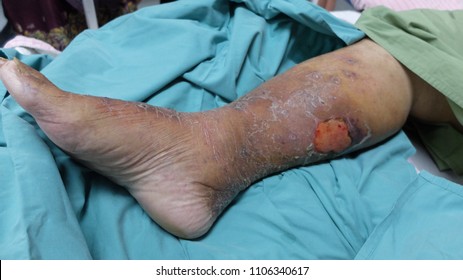 Leg Ulcer Secondary To Cellulitis Preceeded By Blister Formation. Patient Also Has Underlying Chronic Venous Insufficiency.