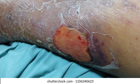 Leg Ulcer Secondary To Cellulitis Preceeded By Blister Formation. Patient Also Has Underlying Chronic Venous Insufficiency.